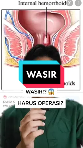 Ambeien / Wasir Bisa Diobati kok #sakitambeien #ambeien #wasir #susahbab #herbalambeien #tiktok #doktermuda #coas #dokter #edukasi #kesehatan #medis #tiktokpelitfyp #fypdongggggggg #fyp #tanyamasko  #foryourpage #fypシ #foryoupage #viraltiktok #viral #bismillahfyp #tiktokpelitfyp