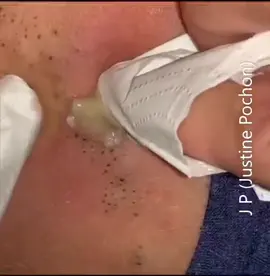 Check link in bio for new extraction tools #popping#removal#extractions#fry#fryp#parati#paravoce#viral#gipleariswing#black#heads#blackhead#pimple#tiktokmademebuyit 
