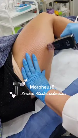 Morpheus8 RF Microneedling for Stretch Marks reduction #morpheus8 #rfmicroneedling #mydubai #dubaiclinic 