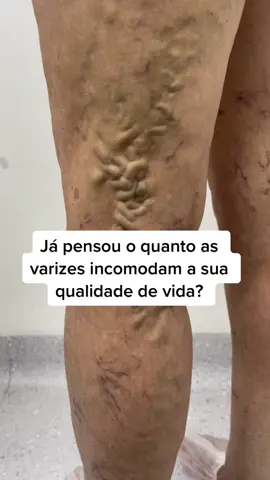 Você já penso o quanto as varizes incomodam a sua qualidade de vida? Não deixe para depois! #esplence #varizes #endolaser #pernas #pernaslindas 