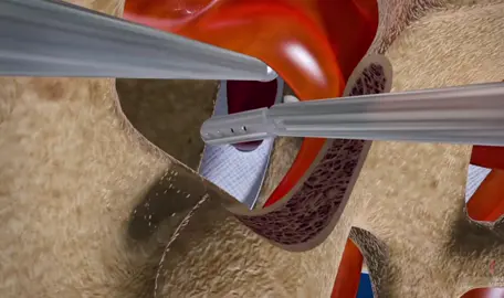 microdisectomy#spine#surgery#back#pain #