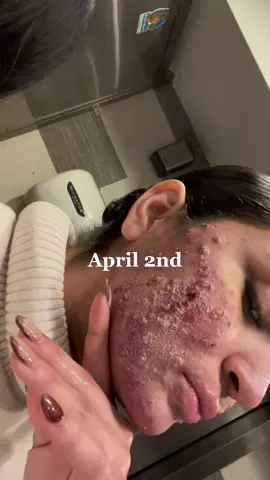 @tiktok don’t take it down it is just acne. I am so happy to announce that today September 4th is my last day on accutane, it has been a beautiful journey and I am so grateful for all the support I received during this 5 months I love y’all 🤍