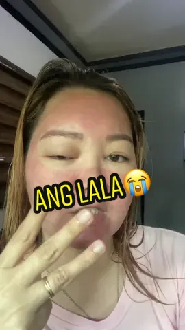 My Co2 Laser Fractional gone wrong😭 #smaxel #co2fractional_laser #fractionallaser #skincare #fractionalshares #lasergonewrong #skincareroutine #neveragain #fyp #fypシ #fypage #becontent 