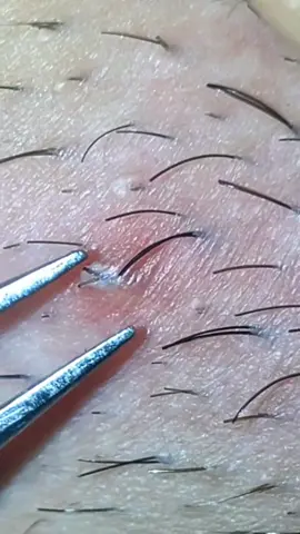 #skincare #foryou #perte #beauty #viralvideo #waxingvideos #extraction #beard #hairingrown #relax #asmr #satisfying #blackhead #hairgrowth #viral #tweezers #satisfyingvideo #hair #asmrvideo #barber #pimple 