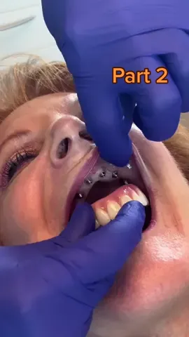 All-on-6 Dental Implants are a better choice because the additional implants provide additional support.  #dentalimplants #oralsurgery #transformation #newyorkusa #newsmilevibe 