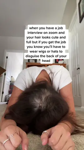 the alopecia struggles ✋🏼😭 #alopecia #alopeciaareata #hairloss #scalppsoriasis #psoriasis #awareness #wigs #helpme #job #jobinterview #eczema #dryskin #crohnsdisease #ibd #depression #MentalHealth #myjourney
