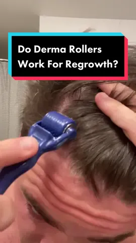 Do derma rollers work for hair regrowth? #hairloss #hairgrowth #dermaroller #hairtok #fyp 