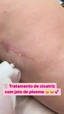 #saoluisdemontesbelos #goias #jatodeplasma #cicatriz #viral #foryou 