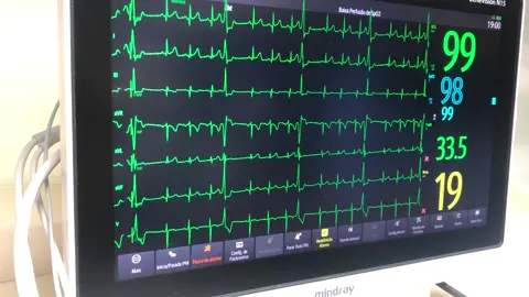 #nurse #enfermagem #medicina #cardiologia #enfermagem #enfermeiro #medico #extrassistoles #ecg #eletrocardiograma 