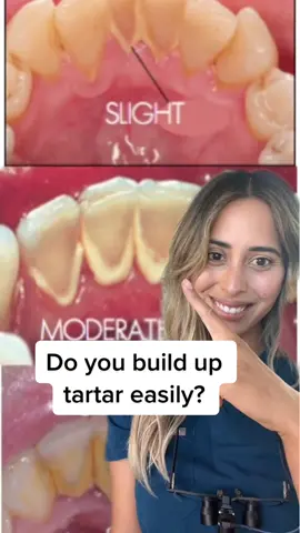 Do you build up tartar/calculus easily regardless of your oral hygiene regimen? #rdh #dental #dentist #tartar #calculusremoval #teethcleaning #toothpaste #thingsyoudidntknow #dentalhygienist 