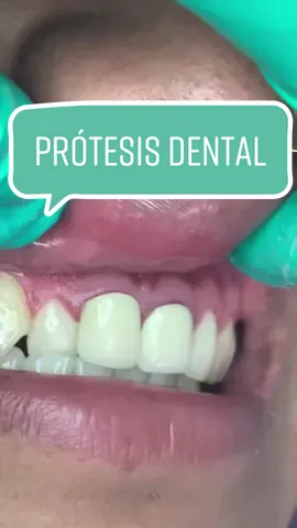El paciente esta feliz con sus nuevas coronas, ya que se asemejan mas a los dientes que tenia antes de las coronas que se retiraron #Protesisdental #odontologiaestetica #dentistaentiktok #aminomegustaamimeencanta 