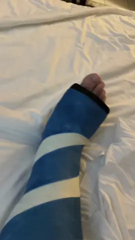 #brokenlegs #legcasts