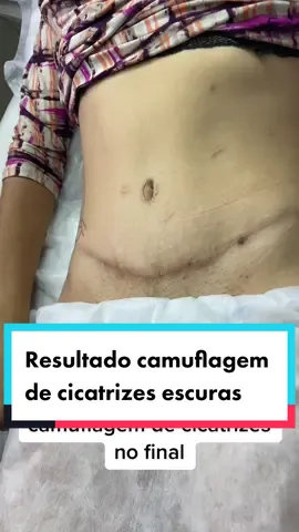 Camuflagem de cicatriz! Resulrado maravilhoso com apenas 1 sessão! WhatsApp link na bio. #camuflagemdecicatriz #camuflagemdeestrias #estrias #cicatriz #cicatrizes #cicatrices #abnominoplastia #cirurgiaplastica #mamoplastia #cirurgia #mastectomia #silicone 