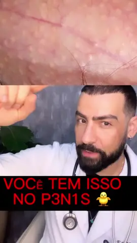 Os grânulos de Fordyce são pequenos pontos amarelados ou esbranquiçados que podem surgir nos lábios, no interior das bochechas ou nos genitais. Estes grânulos são na verdade glândulas sebáceas aumentadas que não causam dor, nem trazem qualquer consequência para a saúde. Os grânulos de Fordyce podem surgir em qualquer idade, mas são mais frequentes na puberdade devido às alterações hormonais. Não estão relacionados a doenças como HIV, herpes, verrugas genitais ou câncer, por exemplo.#granulosdefordyce #urologia #saudedohomem #curiosidades #donadecasa #adolescentes #estudiantedemedicina #estudantesdeenfermagem 