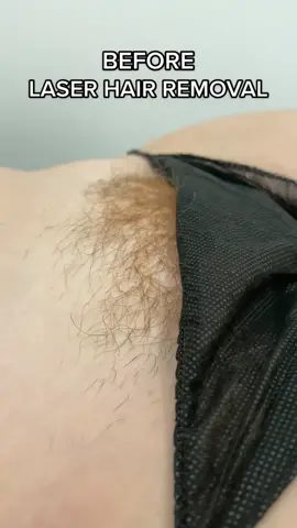 Couldn’t imagine NOT being hair free 🤍 #laserhairremoval #hairfree #hairremoval #laserclinic #trending #beauty #laser #skincare #smoothskin #ingrownhair #satisfying 