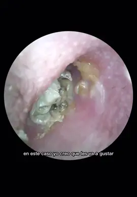 Hongo en oído izquierdo (otitis externa micótica) #oido #humedad #ear #doctor #infeccion #dolor #pain 