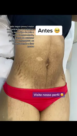 Estrias escuras #pelesaudavel #pele #dermatologist #cuidadodelapiel 