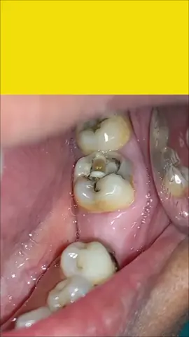 Tooth decay doesn't contain any worms it's all due to bacteria which are not visible to our naked eye. #dentist #drbiplob #nepali #premierdentalnepal #oral #health #awareness #दन्त  #स्वास्थ्य #प्रिमियरडेन्टल #tooth #decay #cavity @rojjjeedon 