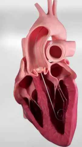 Aortic Stenosis is a type of heart disease where the valve becomes narrowed and doesn’t open properly. #medicalanimation #awareness #heartdisease #interestingfacts 