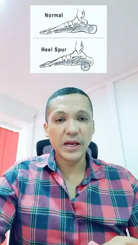heel spur شوكة القدم #dr_saad_maelainin #doctor #health #fypage #دكتور #الدكتور_ماءالعينين_سعد 
