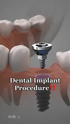 Dental Implants Procedure #animation #surgery #dentist #implant #teeth 