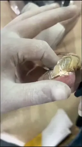 #fungus #mycosis #onychomycosis #fungaltoenail #fungaltoenailtreatment #toenailtreatment #footpain #fyp #satisfying #relaxing #viralvideo @footworksrelaxingvideos 