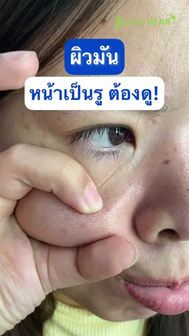 หน้ามัน หลุมสิวกว้าง ต้องใช้!! #จุฬาเฮิร์บ #เซรั่มขิงดํา #เจลมะรุม #ผิวมัน #รูขุมขนกว้าง #รอยสิว #รอยดํา #รอยแดง #หลุมสิว #รีวิวบิวตี้ #รีวิวเซเว่น