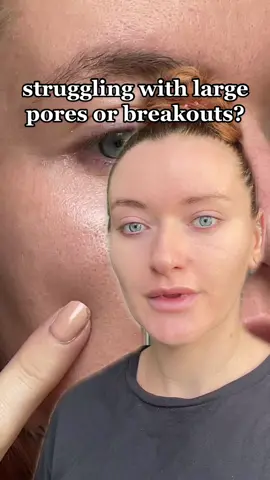at-home peels are AMAZING at keeping pores clean of excess sebum which can lead to breakouts and blackheads! our new Clear Start Breakout Clearing Peel uses 10% AHA and 2% BHA to keep skin clear WITHOUT damaging your skin barrier! use 1-2x per week & leave on for 5-10mins 🥰✨ #skincare #skincaretips #peel #chemicalpeel #breakouts #pores 