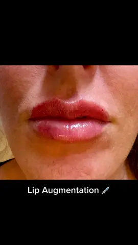 👄 #aesthetic #aesthetics #lips #filler #medicine #beautiful #doctor #viral #foryou #foryoupage #fyp #trending #perfect 
