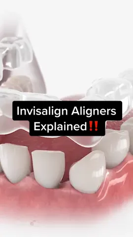 How Does Invisalign Aligners Straighten Teeth #animation #teeth #orthodontist #invisalign 