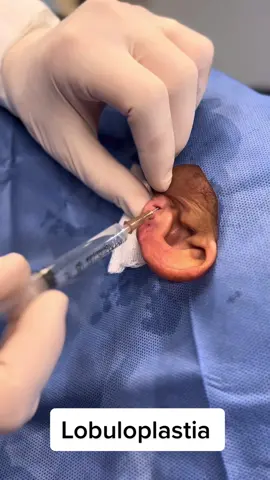 Ja ouviu falar em Lobuloplastia? #lobuloplastia #cirugia #fyp 
