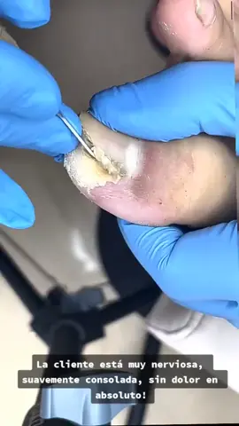 #ingrowntoenail #ingrownnail #ingrown #ingrowntoenailremoval #footpain #fyp #ingrowntoenailsurgery #stubborn #granuloma  #satisfying #relaxing #viralvideo @footworksrelaxingvideos 