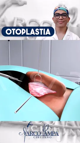 OTOPLASTIA #otoplastia #cirugiadeorejas #orejasgrandes #oreja #orejas #otoplasty #otoplastiacheck #orejasgrandes #orejon #cirugiaestetica #viral #foryou #tiktok 