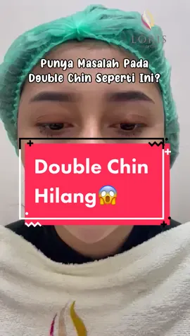 Double Chin Mengganggu Tampilan Kamu? Jangan khawatir lorisbeautyclinic solusinya! #doublechinreduction #tariktambang #fyp #lorisbeautyclinic #treatmentwajah 