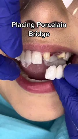 #dentalbridge #porcelainbridge #cosmeticdentist #beverlyhillsdentist #trending #teeth #dental 