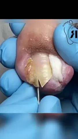 #ingrowntoenail #ingrownnail #ingrown #ingrowntoenailremoval #footpain #fyp #ingrowntoenailsurgery #stubborn #granuloma  #satisfying #relaxing #viralvideo @footworksrelaxingvideos 