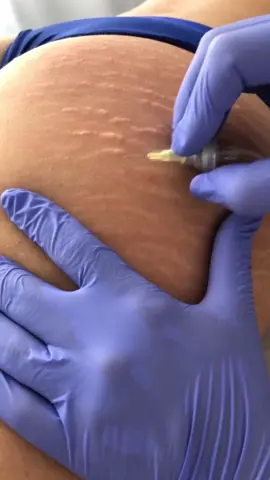 Carboxiterapia combate estrias de maneira eficiente através da infusão de CO2 medicinal na pele.  Muitas pacientes perguntam: a técnica dói ? Adivinha o que faço para proporcionar mais conforto a paciente: preparo a pele aumentando a oxigenação tecidual. Fica bem tranquilo após a realização das aplicações. #gentelinda #tratamentoscorporais #tratamentosestéticos #estrias #clinicapriscilasantos 