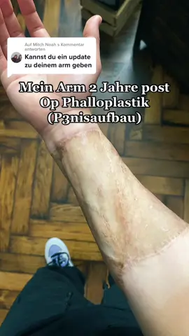 Antwort auf @Mitch Noah  Mehr Updates gibts auf YouTube 😊 (Link in bio) #trans #transgender #phalloplasty #bottomsurgery #ftm #ftmtransgender #transition 