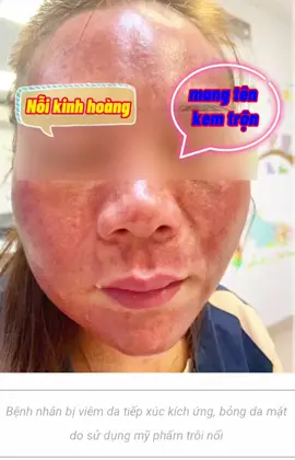 # kem trộn, kem giả gây tác hại kinh khủng## hãy là người tiêu dùng thông minh#