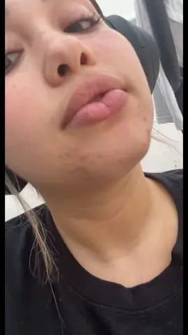 L’avant après de ma soeur, tous ses boutons ont disparu après avoir utilisé le nettoyant anti acné que je montrais dans la routine de madison beer #acne #boutons #panoxyl #madisonbeer 