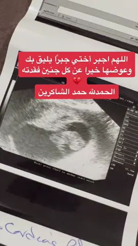 #اجهاض #الحمل #alhamdulileh #baby #اللهم_اشفي_مرضانا_ومرضى_المسلمين 