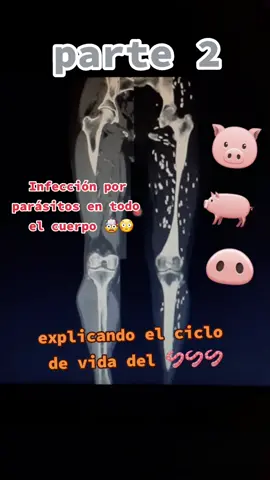 parte 2 del caso impresiona debido a infección por parásitos #health #salud #viral #tiktok #fy #fyp #radiologist #radiologia ##medicosdetiktok #tomografia #tomografy #parasitos #parasite #cisticercosis #infeccion #teniasis #larva 