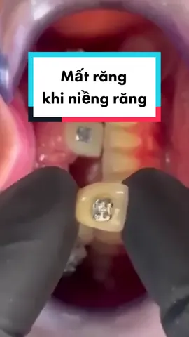 Không sợ xấu trong quá trình niềng bằng những chiếc răng tạm #rangtam #niengrang #chinhnha #maccaikimloai #matrang #LearnOnTikTok  