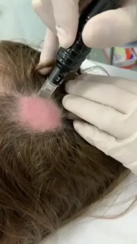 A alopecia areata é uma doença autoimune que também pode ser tratada com MMP.  Assista esse vídeo para saber como funciona o tratamento e se tiver dúvidas sobre o assunto escreva nos comentários e eu esclareço para você.  #tricologia #cabelos #alopecia #quedadecabelos #calvície #cabelosfrageis #mmpcapilar 