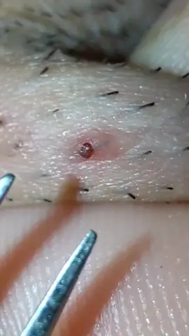 #pimple #ingrownhair #skincare #beard #tweezers #extraction 