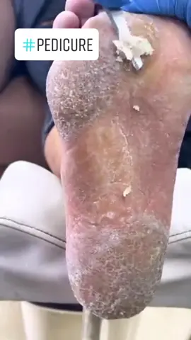 #footpain #fyp #viralvideo #satisfying #callusremoval #painful #podiatry #satisfyingvideo #myfootarekillingme #callus #trendingvideo #calluses #healthyfeetpodiatry #pedicure #crackedfeet @footworksrelaxingvideos 