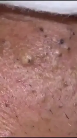 #foryou #pourtoi #fyp #boutons #boutondacné #boutonsurlagueule #pimples #pimple #skin #skincare #pimpleremoval #pimplepopper #pimpleremover #pimplepop #explosion 