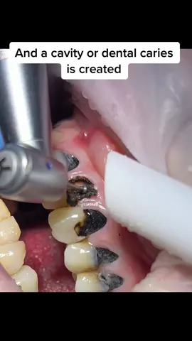 Dental caries is the most common noncommunicable disease worldwide!! #fyp #caries #awareness #teeth #dentist #viral #goviral #denhaag  #dentaldiamondtp #vjp #ptp 