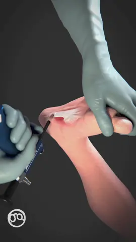 The plantar fascia is a band of tissue (fascia) that connects your heel bone to the base of your toes. It supports the arch of the foot and absorbs shock when walking. Tension and stress on the fascia can cause small tears.  Plantar fascia release surgery involves cutting part of the plantar fascia ligament to release tension and relieve inflammation of the ligament (plantar fasciitis). Your doctor can use medicine that numbs the area (local anesthetic) for the procedure.  MicroAire SmartRelease is designed for transecting the transverse carpal ligament and fascia of the cubital tunnel, recession of the plantar fascia, and gastrocnemius aponeurosis.  Comprised of an endoscope and a handpiece that holds an elongated, disposable blade assembly, the MicroAire SmartRelease System connects to any standard video camera and light source. The surgeon introduces the blade assembly into the carpal tunnel through a limited incision in the wrist flexor crease.  Learn how Ghost Productions Medical Animation Studio & Surgical VR Developer can help you explain how your medical devices and pharmaceutical products work. Website Link is in our bio.   #footpain #footsurgery #medicaltiktok #awareness #surgicalanimation 