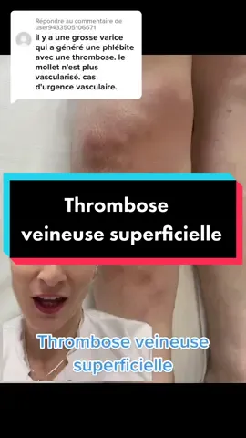 Réponse à @user9433505106671 #pourtoi #hopital #worldthrombosisday 